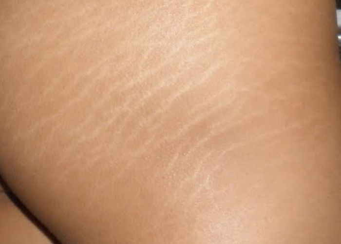 kem trị sẹo và rạn da