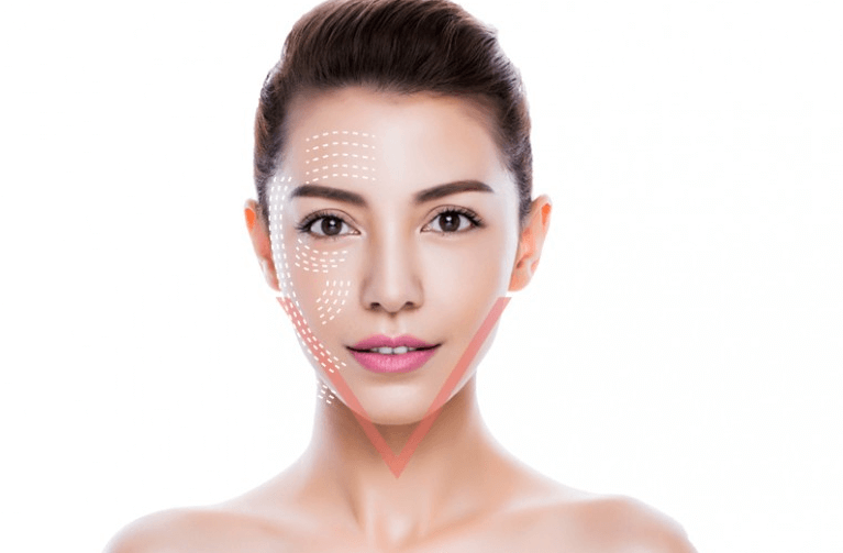 nâng cơ mặt có hiệu quả không