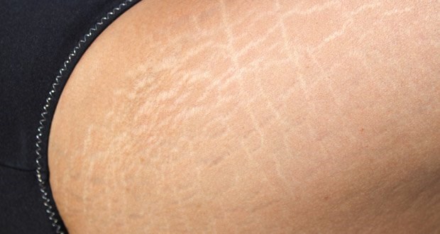 kem trị rạn da lâu năm hiệu quả