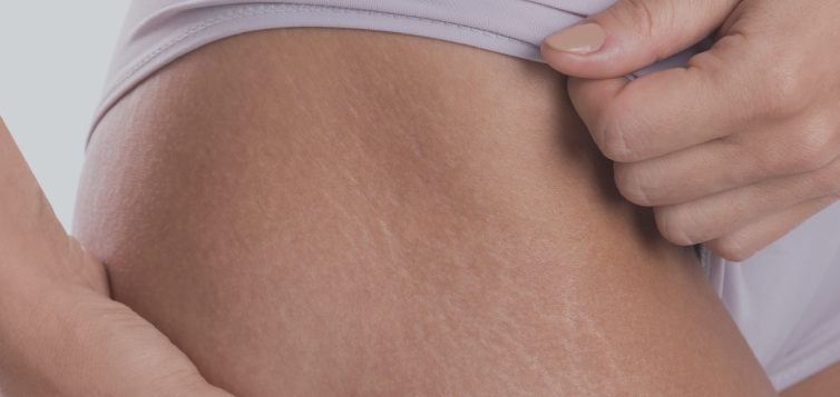 rạn da ở tuổi dậy thì